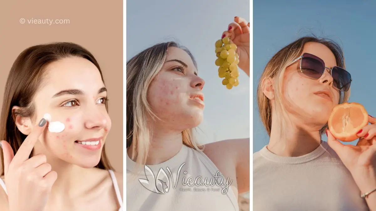 Best Home Remedies for Acne: Treat Acne at Home 9 best-home-remedies-for-acne-treat-acne-at-home